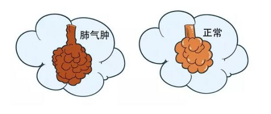 一起来了解慢阻肺